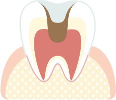 神経に到達した虫歯